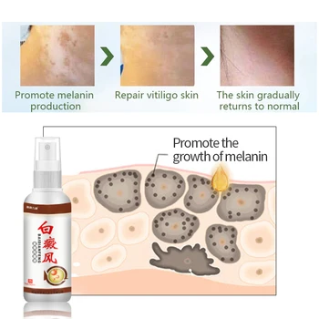 50 ml Liječenje Vitiligo Sprej Za Uklanjanje Bijelih Mrlja Krema Za Liječenje Микоза Лейкоплакии Мелагенина Plus Antibakterijski Lijek