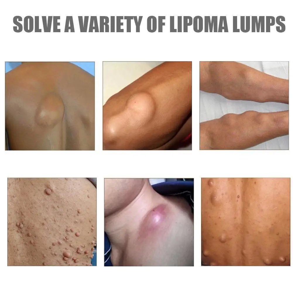1Pcs Lipoma Verwijdering Crème Behandelen Tumor Huid Zwelling Zalf Exfoliërende Pijnrijding Lichaam Gezondheidszorg Gips Slika  4