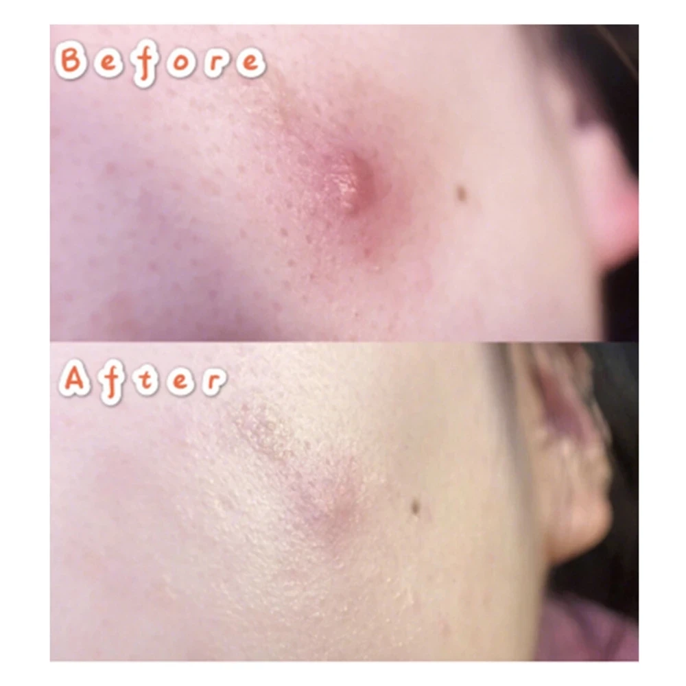 LANBENA Akne od Akni Krpa Nevidljive Naljepnice od acne Liječenje Akni Majstor Za Uklanjanje akni Kozmetički Alat Za Njegu Kože Slika  1